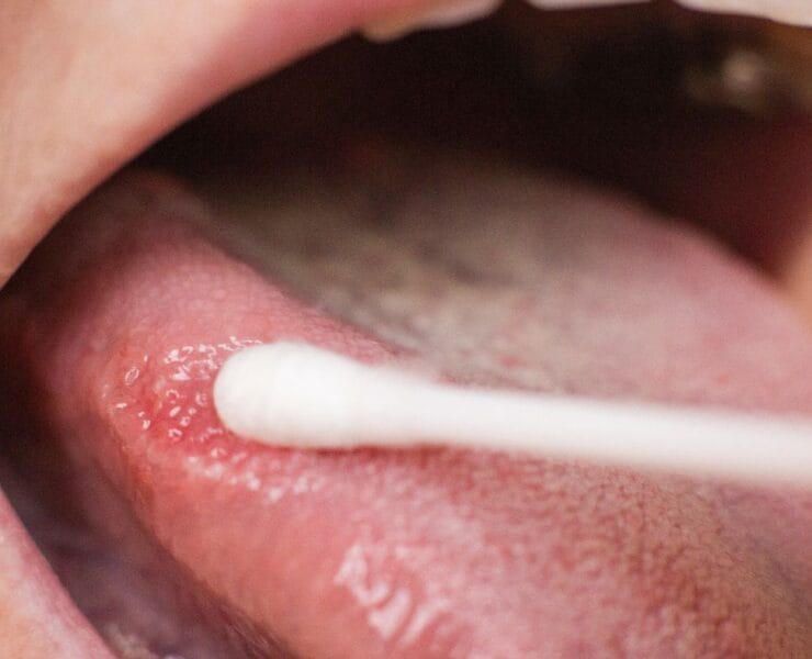 Afta na języku: Przyczyny, objawy i leczenie
